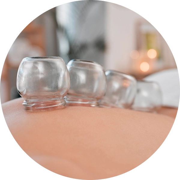 Cupping therapy on person's back.